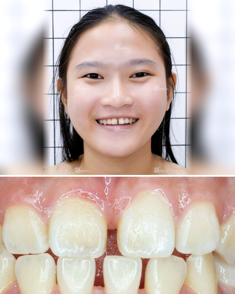 Trước điều trị