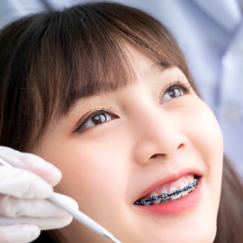 Niềng Mắc Cài 3M