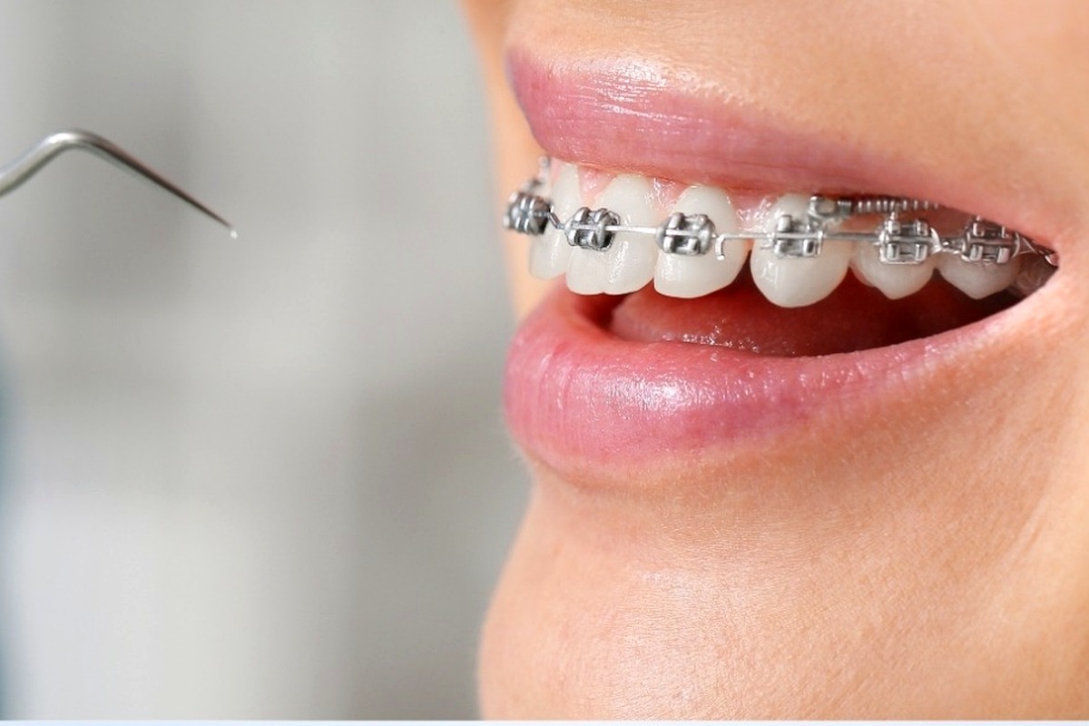 Khay Invisalign & Mắc cài
