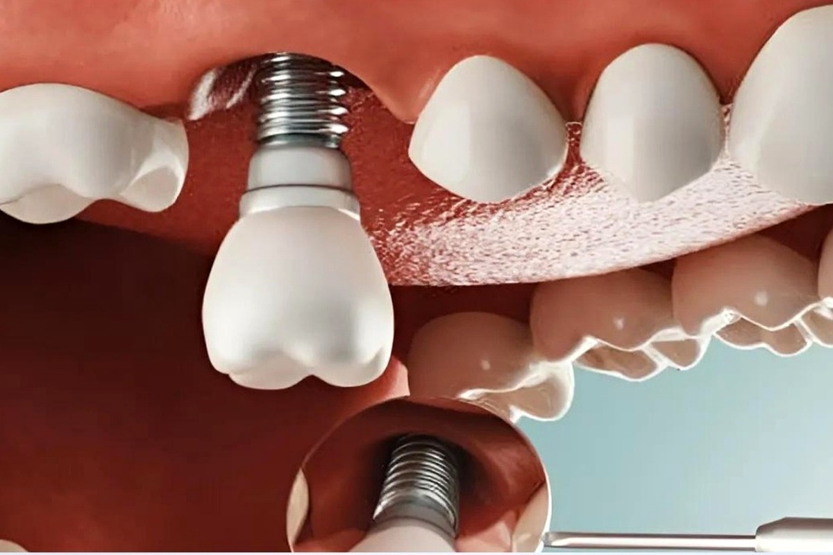 Trồng răng Implant có đau không?