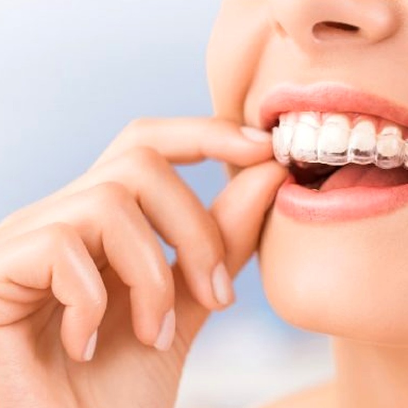 Niềng Răng Invisalign