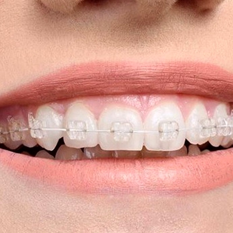 Niềng Mắc Cài Sứ Tự Buộc