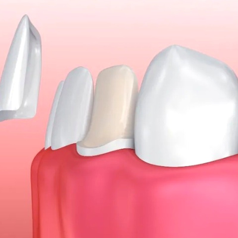 Dán Sứ Veneer Emax